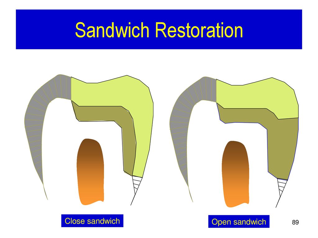 Management of Posterior Smooth Surface Caries ppt